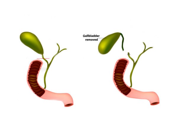 Is Cholecystectomy Responsible for Causing Incontinence? - Consure Medical